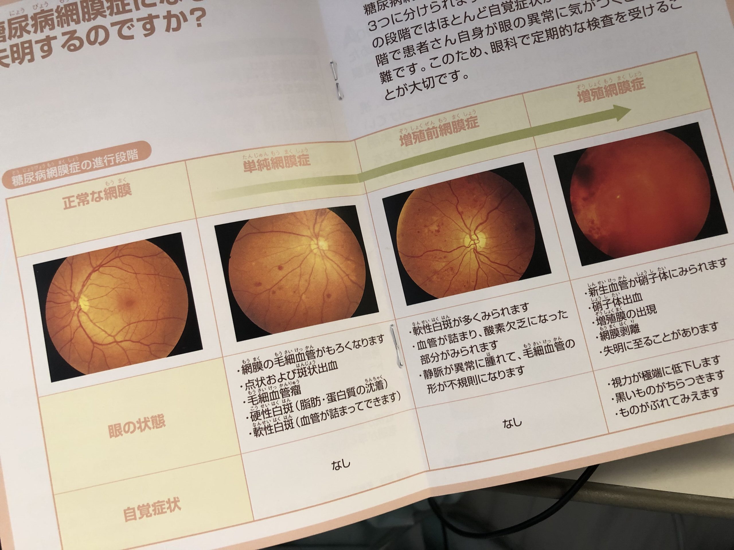 糖尿病は黄斑浮腫を引き起こしますか?